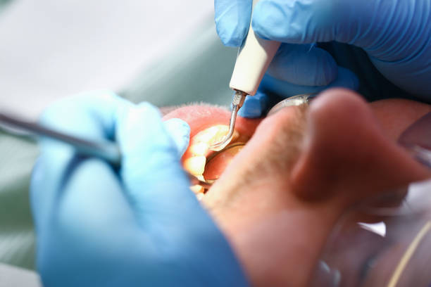 Best Emergency Dental Care for Abscessed Tooth in Delhi, LA